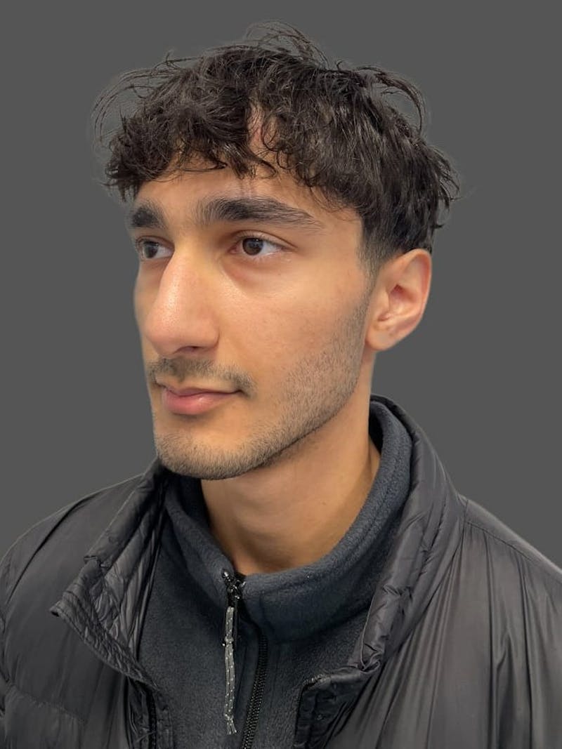 Rhinoplasty Before & After Gallery - Patient 103960 - Image 3