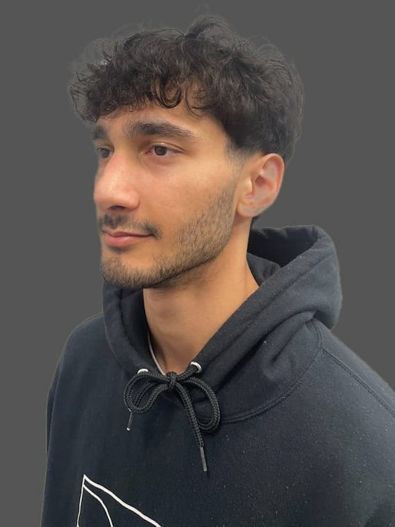 Rhinoplasty Before & After Gallery - Patient 103960 - Image 4