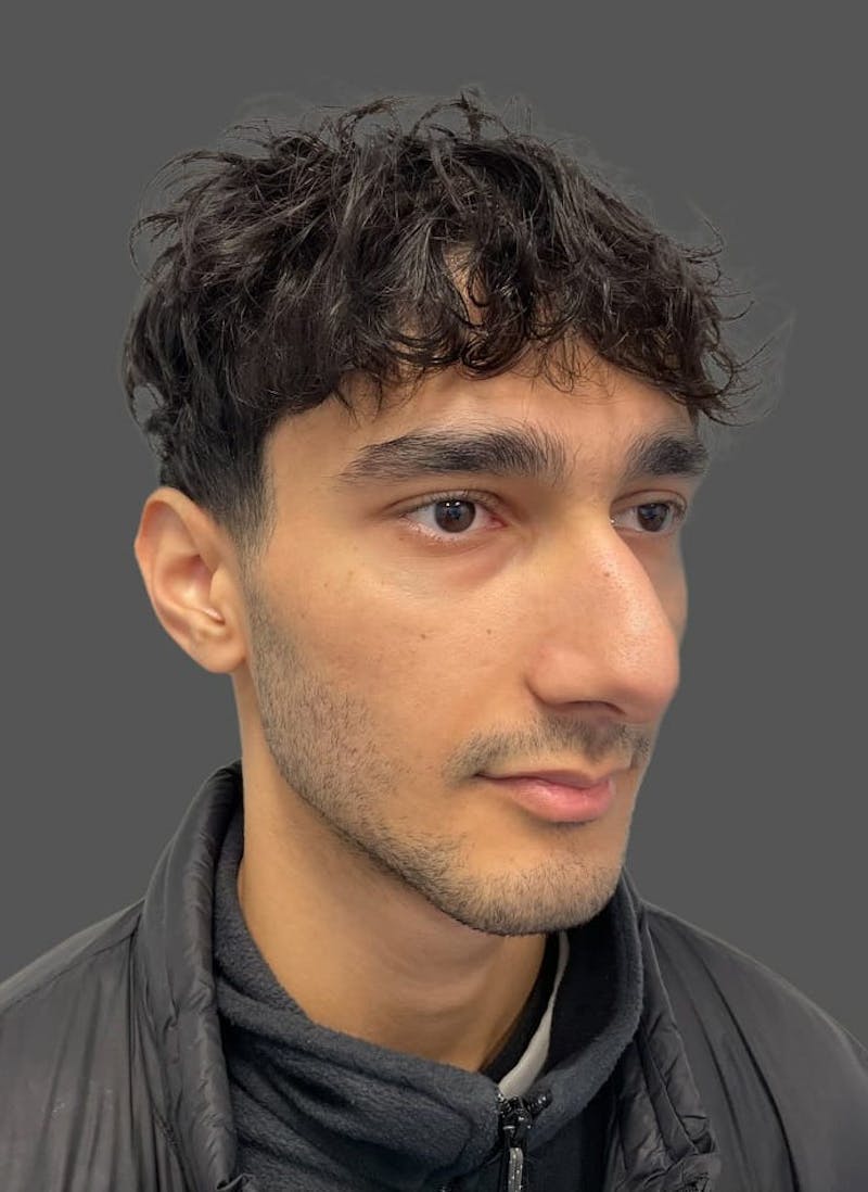 Rhinoplasty Before & After Gallery - Patient 103960 - Image 5