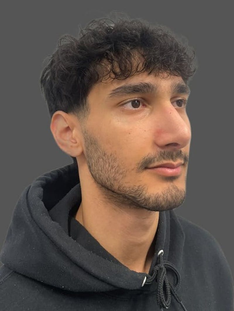 Rhinoplasty Before & After Gallery - Patient 103960 - Image 6