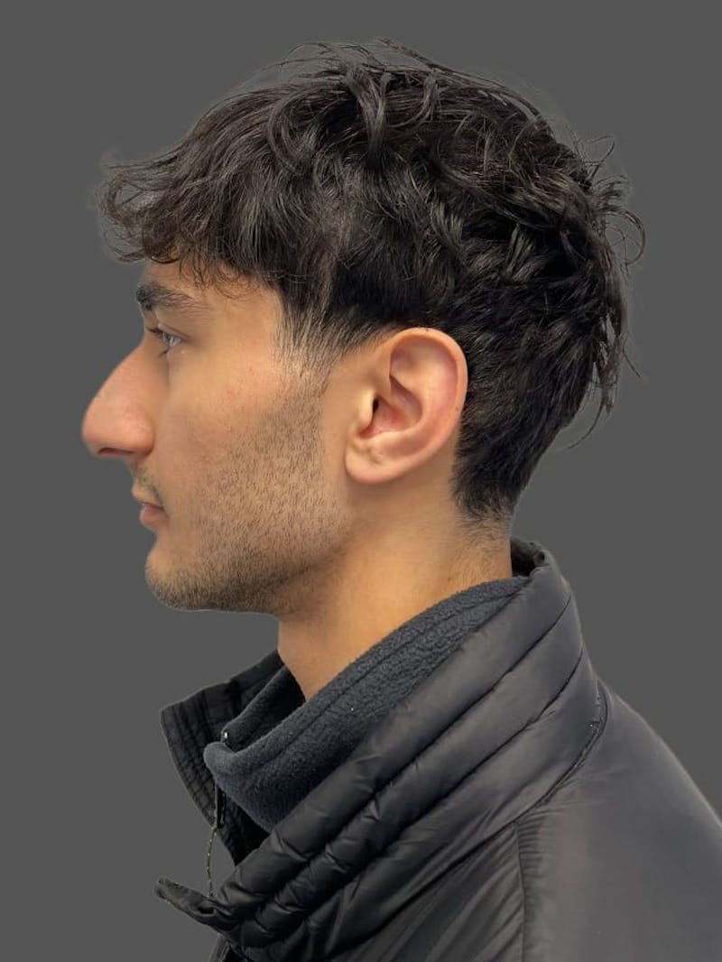 Rhinoplasty Before & After Gallery - Patient 103960 - Image 1