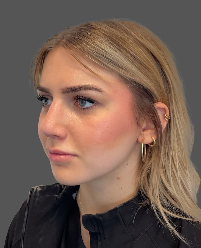 Rhinoplasty Before & After Gallery - Patient 142892 - Image 4