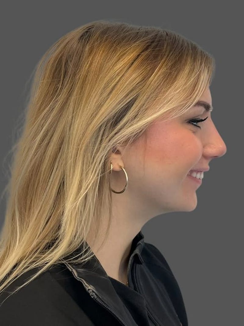 Rhinoplasty Before & After Gallery - Patient 142892 - Image 6