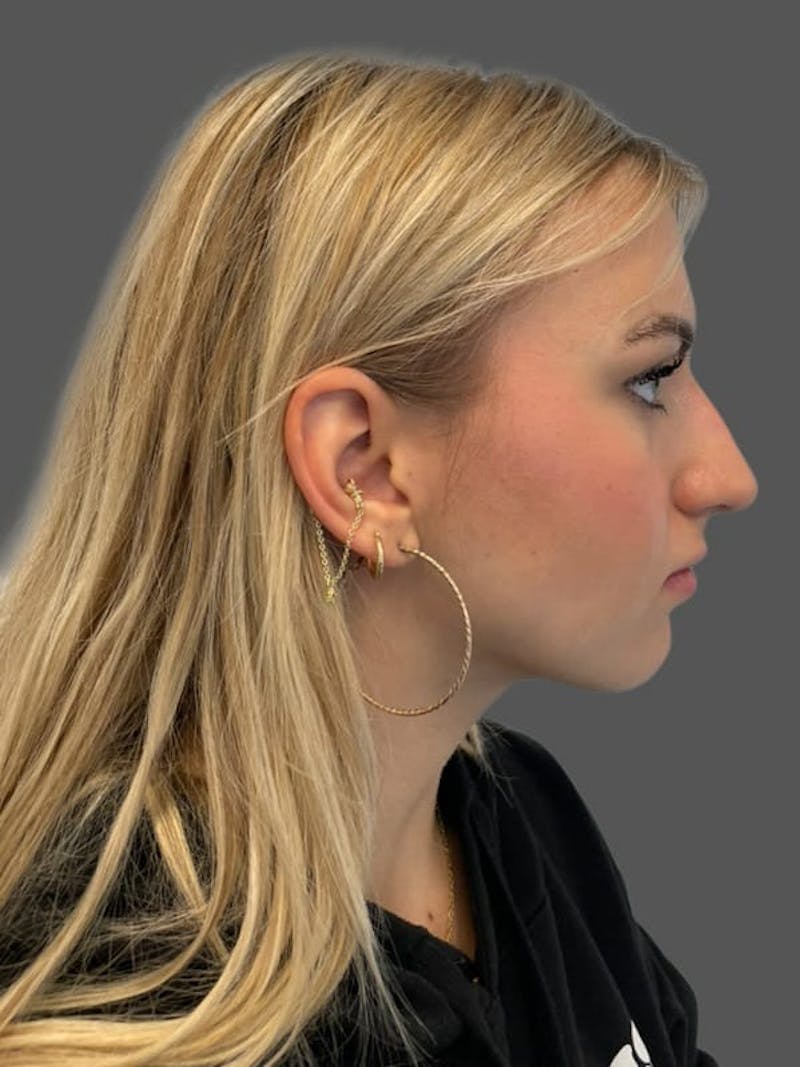 Rhinoplasty Before & After Gallery - Patient 142892 - Image 5
