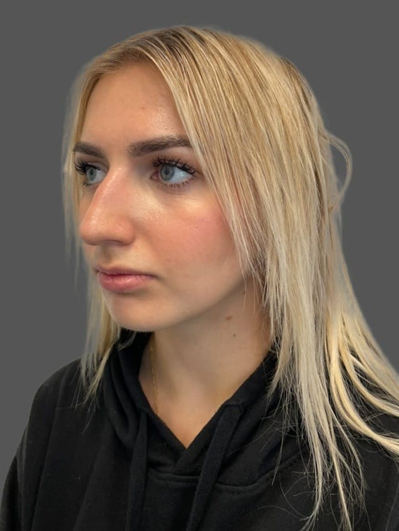 Rhinoplasty Before & After Gallery - Patient 142892 - Image 3