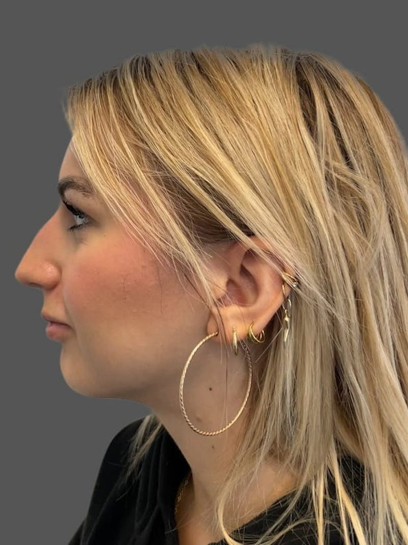 Rhinoplasty Before & After Gallery - Patient 142892 - Image 1