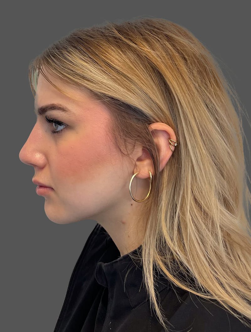 Rhinoplasty Before & After Gallery - Patient 142892 - Image 2