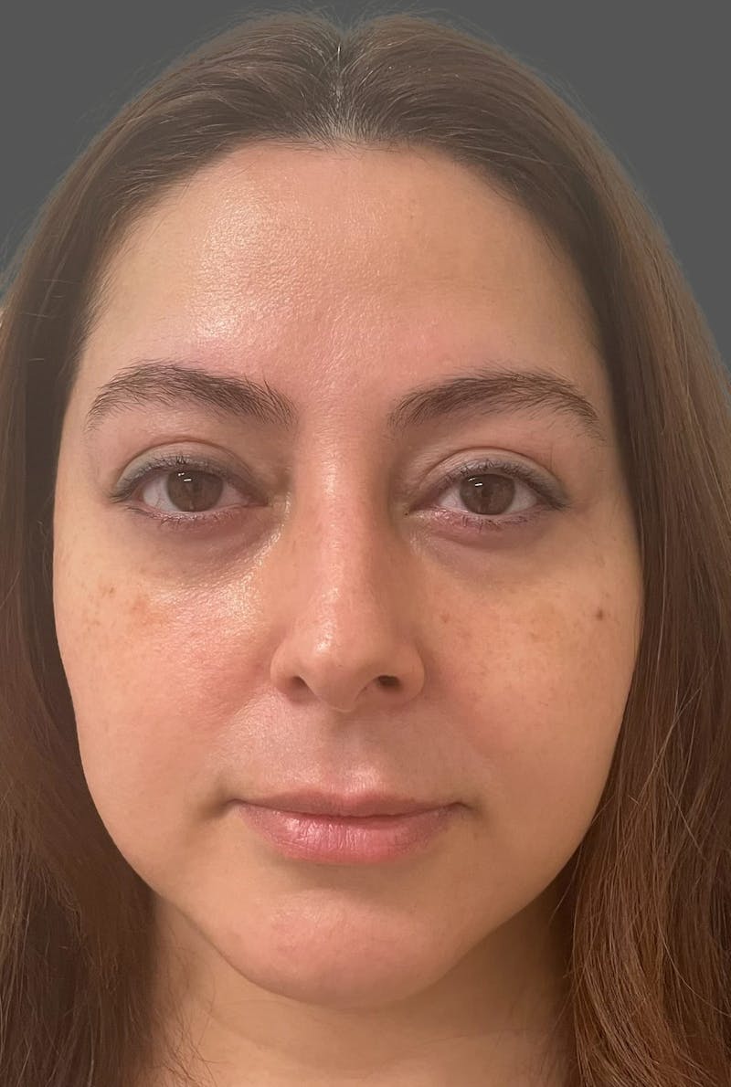 Rhinoplasty Before & After Gallery - Patient 325578 - Image 7