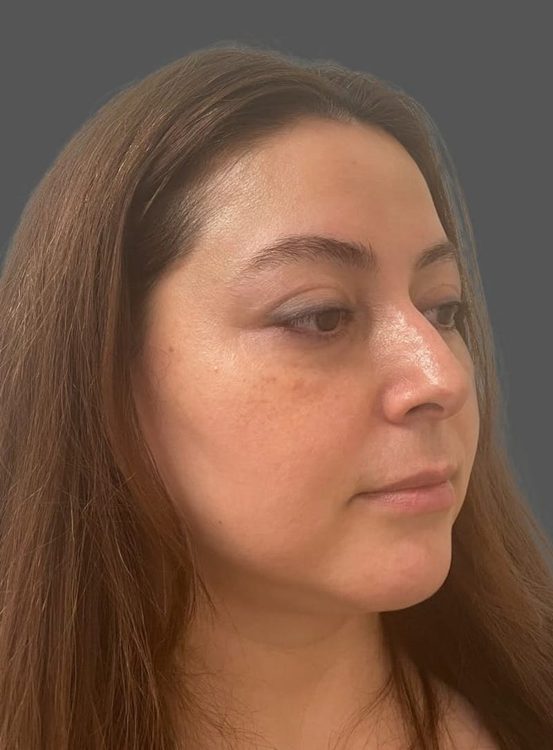Rhinoplasty Before & After Gallery - Patient 325578 - Image 3