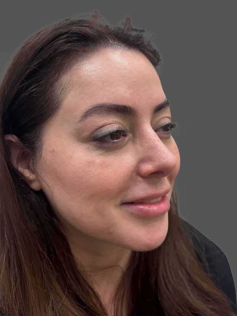 Rhinoplasty Before & After Gallery - Patient 325578 - Image 4