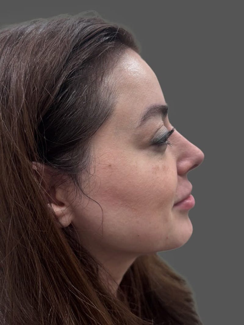 Rhinoplasty Before & After Gallery - Patient 325578 - Image 2
