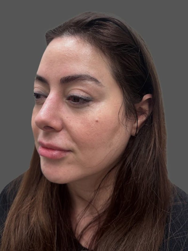 Rhinoplasty Before & After Gallery - Patient 325578 - Image 6