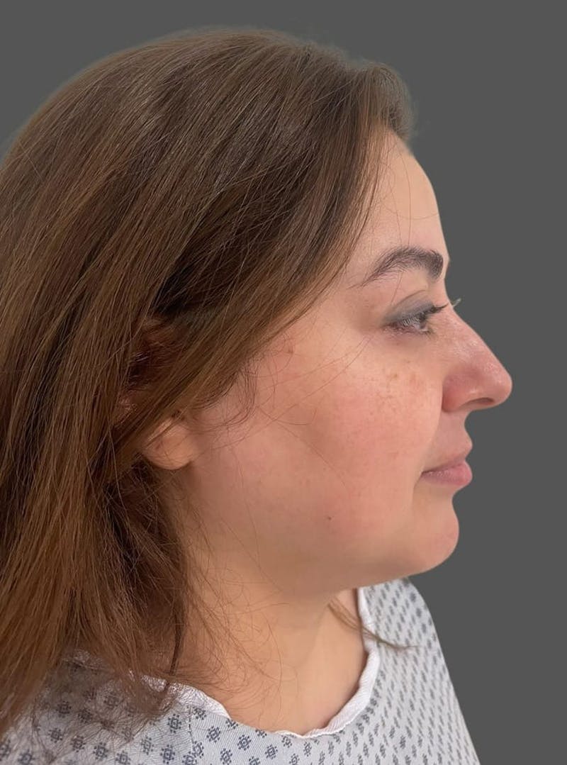 Rhinoplasty Before & After Gallery - Patient 325578 - Image 1