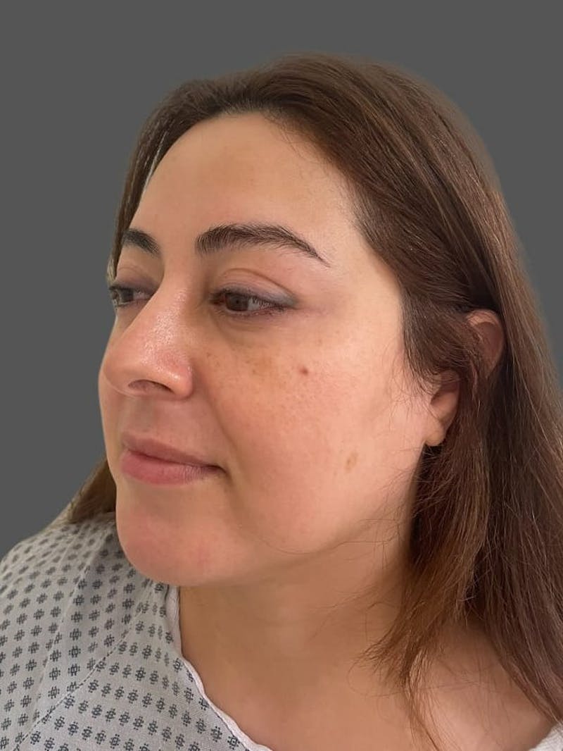 Rhinoplasty Before & After Gallery - Patient 325578 - Image 5