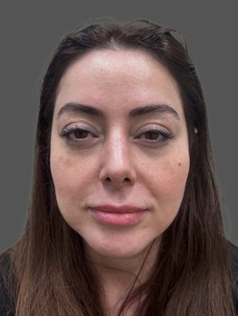Rhinoplasty Before & After Gallery - Patient 325578 - Image 8