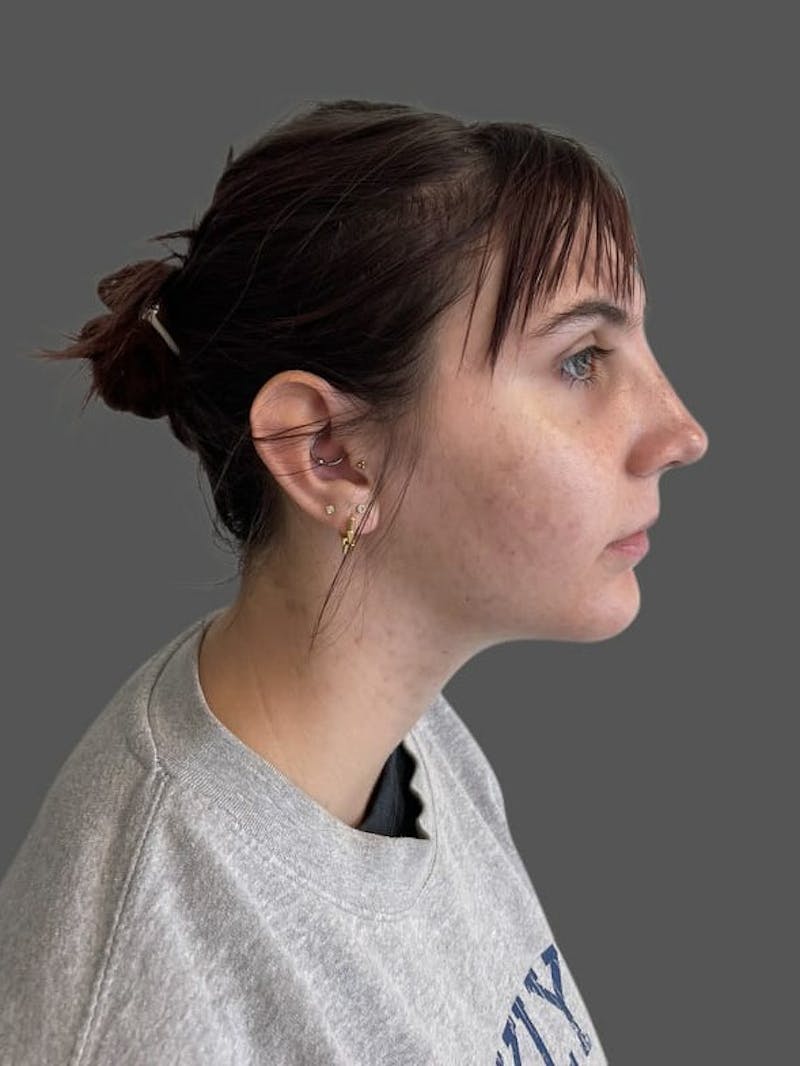 Rhinoplasty Before & After Gallery - Patient 335106 - Image 4