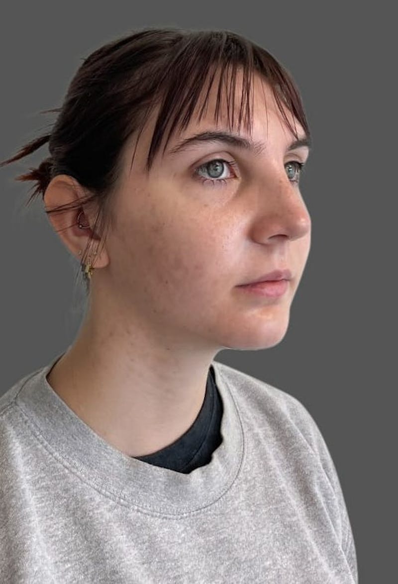 Rhinoplasty Before & After Gallery - Patient 335106 - Image 6