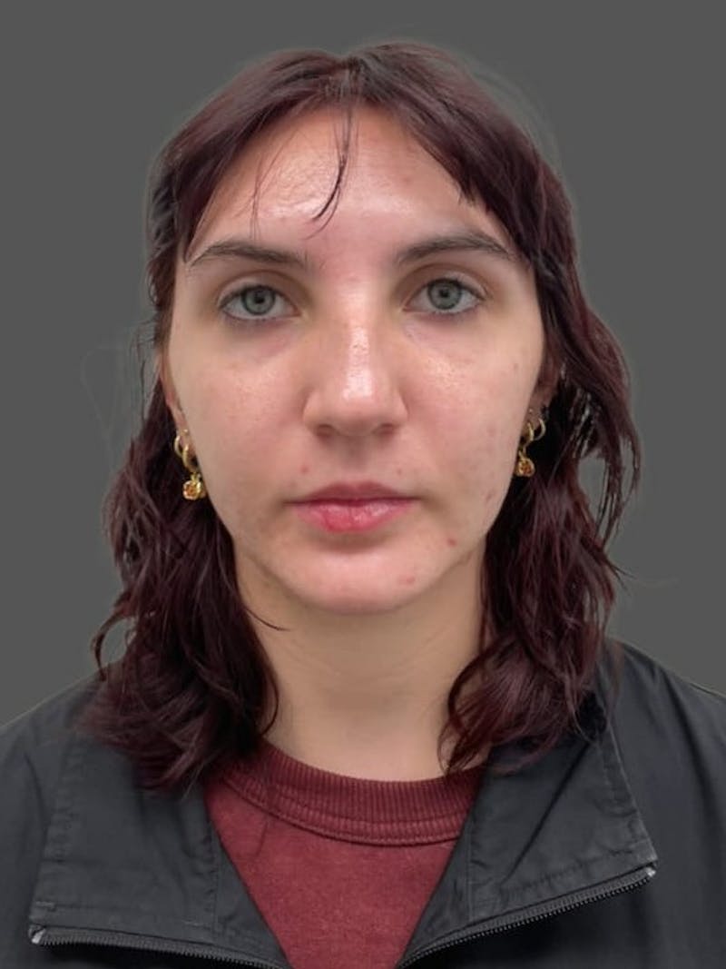 Rhinoplasty Before & After Gallery - Patient 335106 - Image 9
