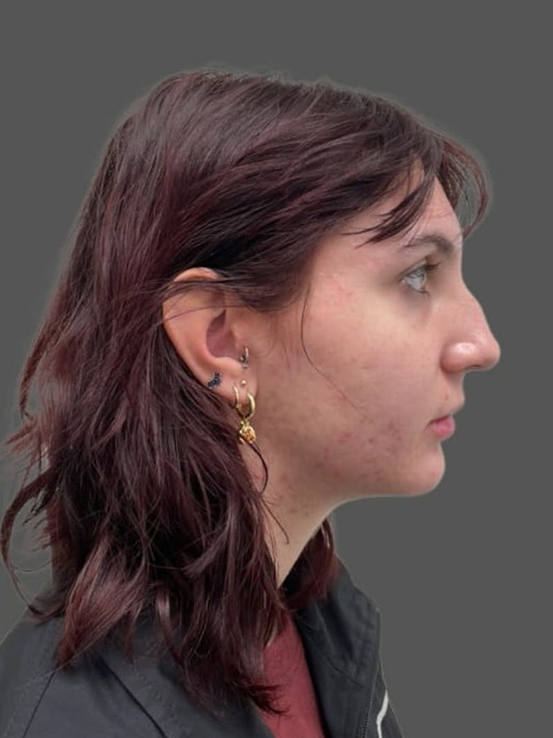 Rhinoplasty Before & After Gallery - Patient 335106 - Image 3