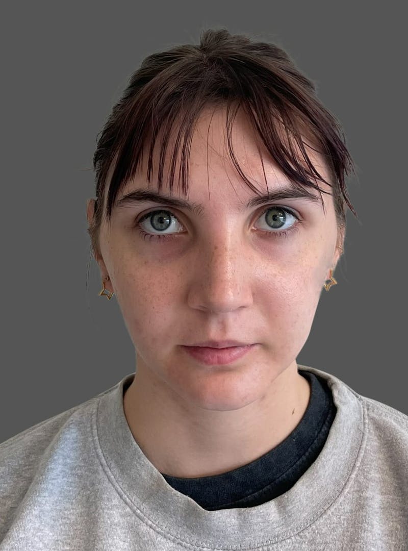 Rhinoplasty Before & After Gallery - Patient 335106 - Image 10