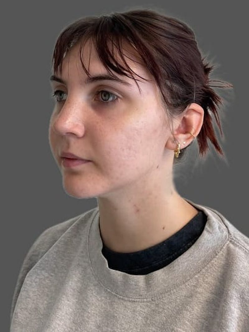 Rhinoplasty Before & After Gallery - Patient 335106 - Image 8