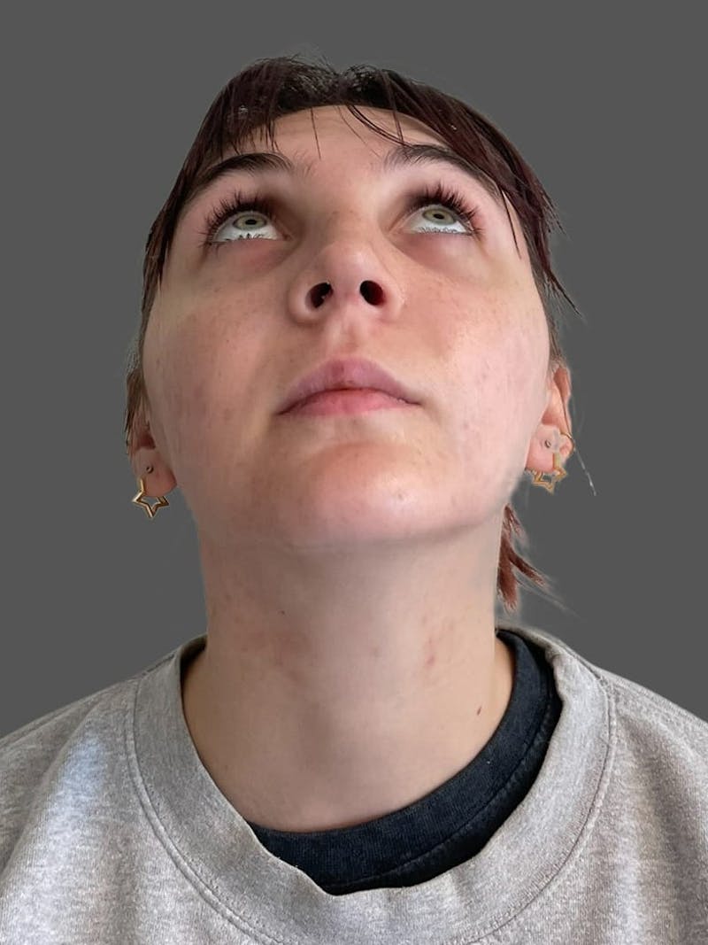 Rhinoplasty Before & After Gallery - Patient 335106 - Image 12