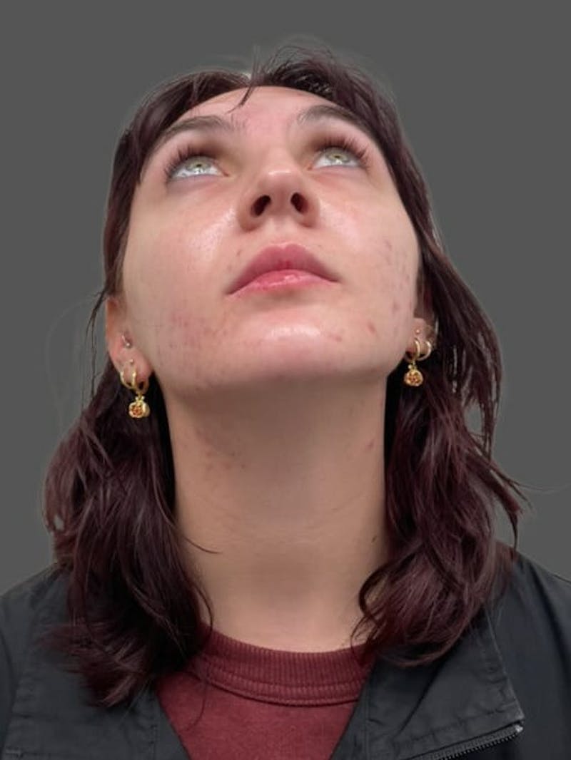 Rhinoplasty Before & After Gallery - Patient 335106 - Image 11