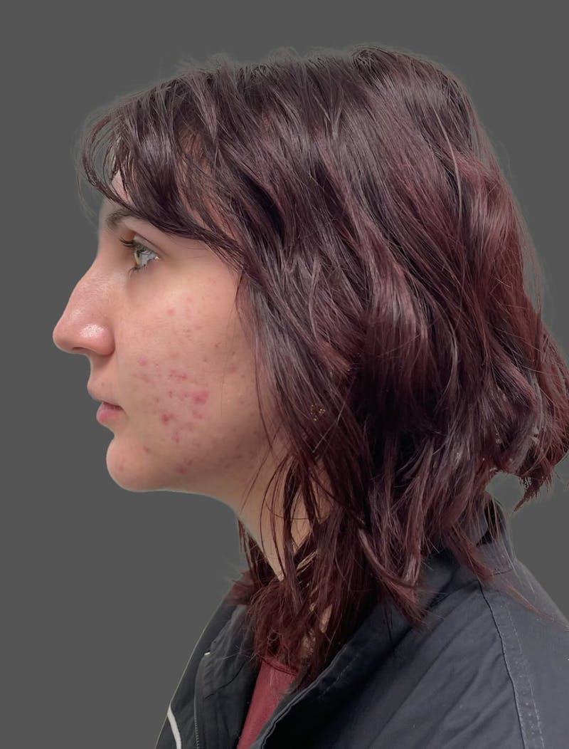 Rhinoplasty Before & After Gallery - Patient 335106 - Image 1
