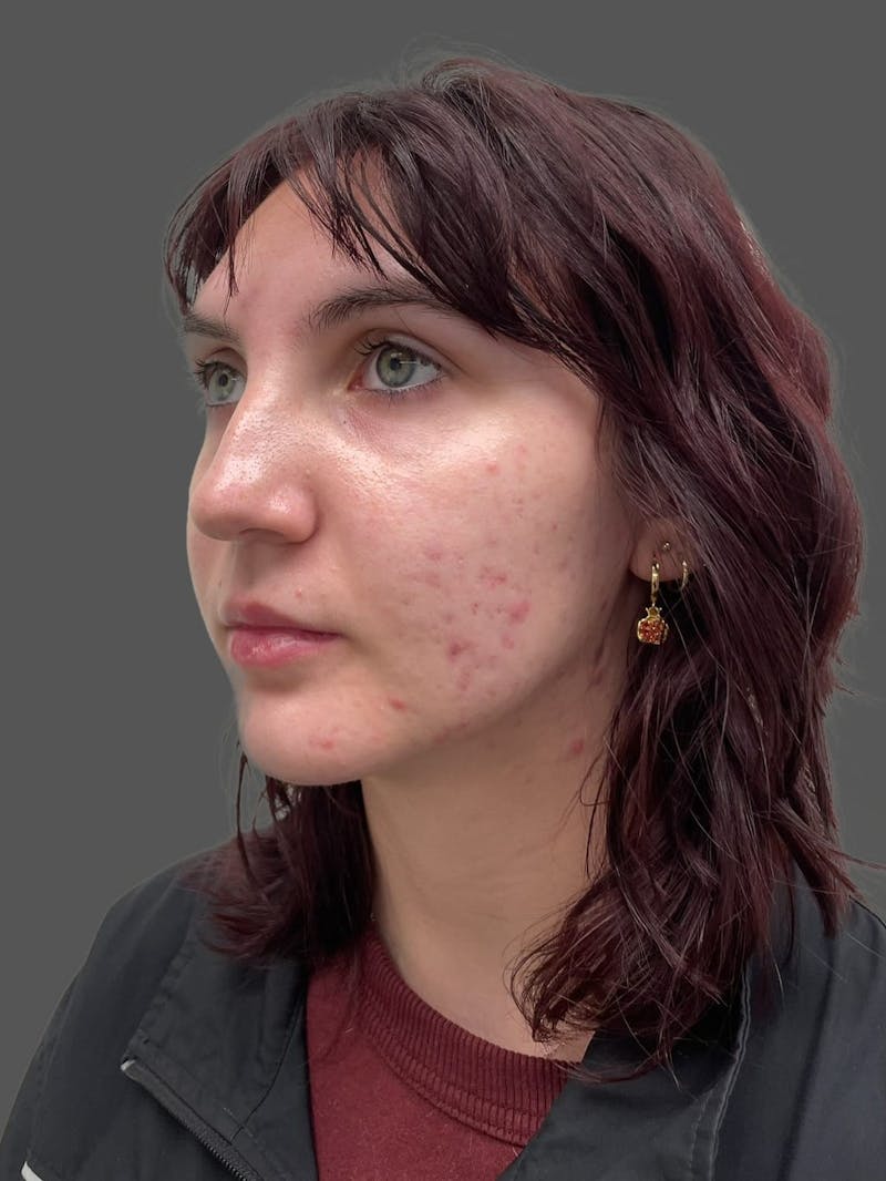 Rhinoplasty Before & After Gallery - Patient 335106 - Image 7