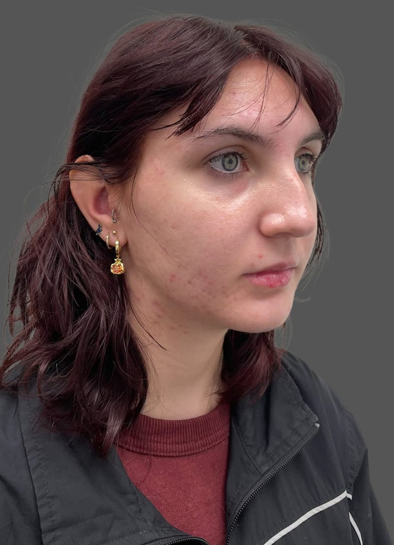 Rhinoplasty Before & After Gallery - Patient 335106 - Image 5
