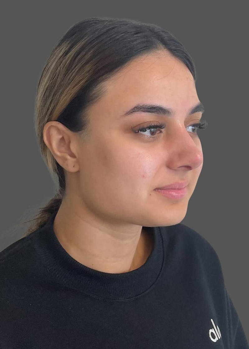 Rhinoplasty Before & After Gallery - Patient 175608 - Image 4