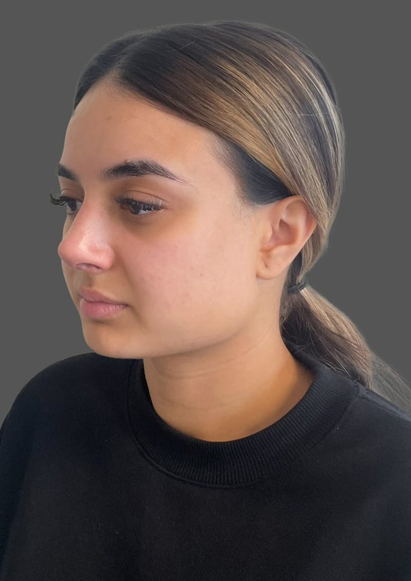 Rhinoplasty Before & After Gallery - Patient 175608 - Image 6