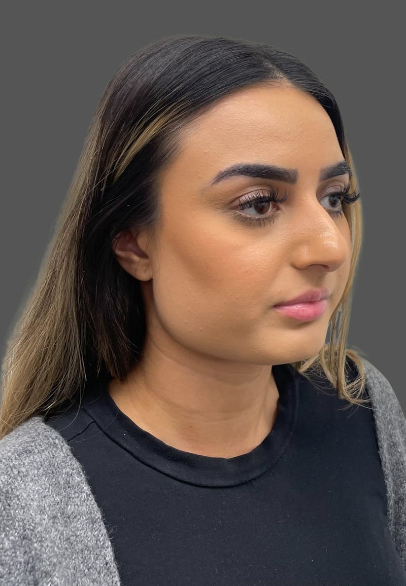 Rhinoplasty Before & After Gallery - Patient 175608 - Image 3