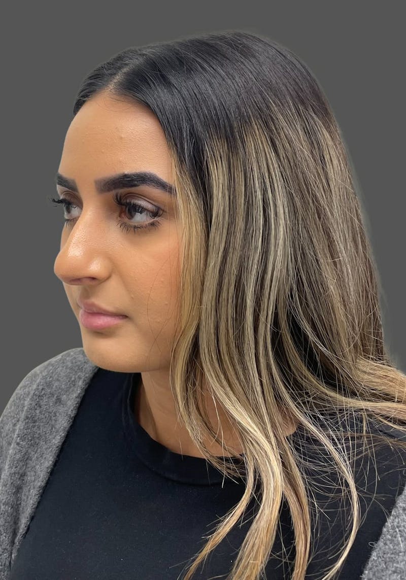 Rhinoplasty Before & After Gallery - Patient 175608 - Image 5