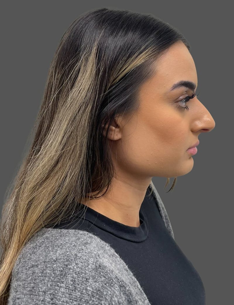 Rhinoplasty Before & After Gallery - Patient 175608 - Image 1