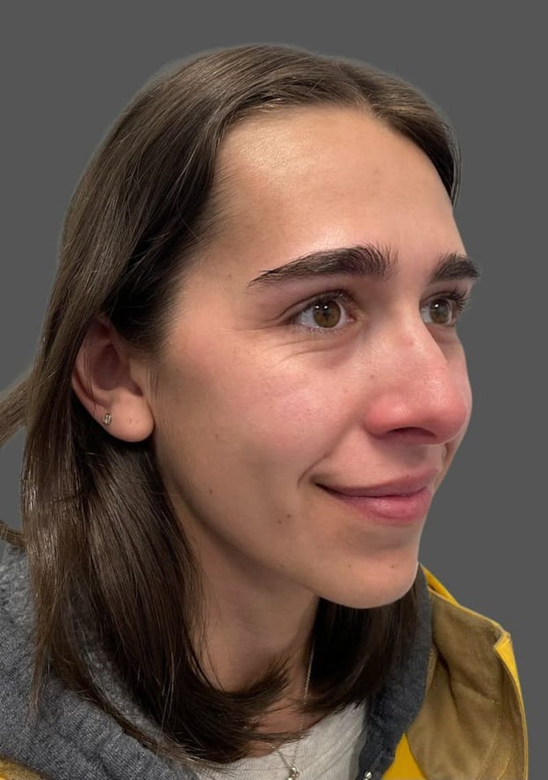 Rhinoplasty Before & After Gallery - Patient 600754 - Image 3