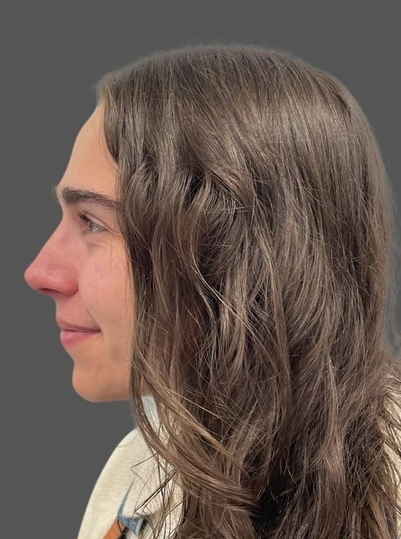Rhinoplasty Before & After Gallery - Patient 600754 - Image 2