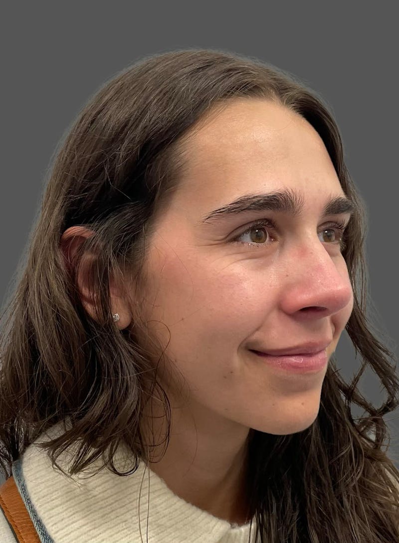 Rhinoplasty Before & After Gallery - Patient 600754 - Image 4