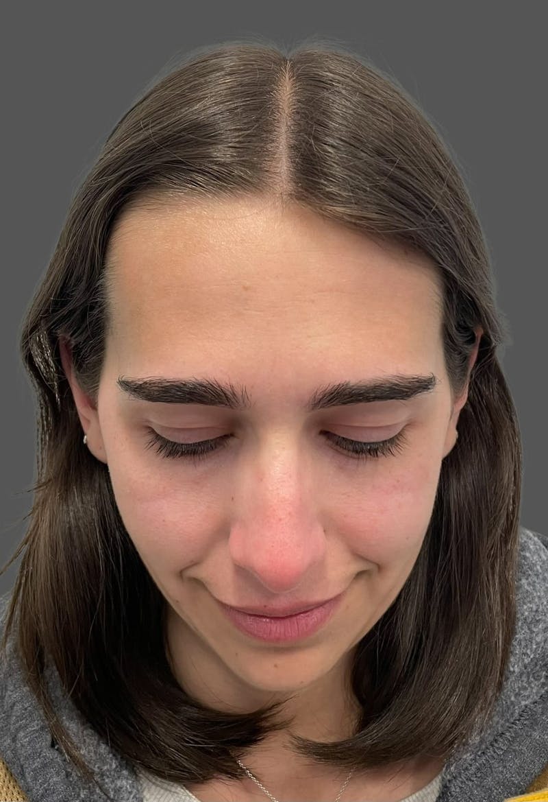 Rhinoplasty Before & After Gallery - Patient 600754 - Image 11
