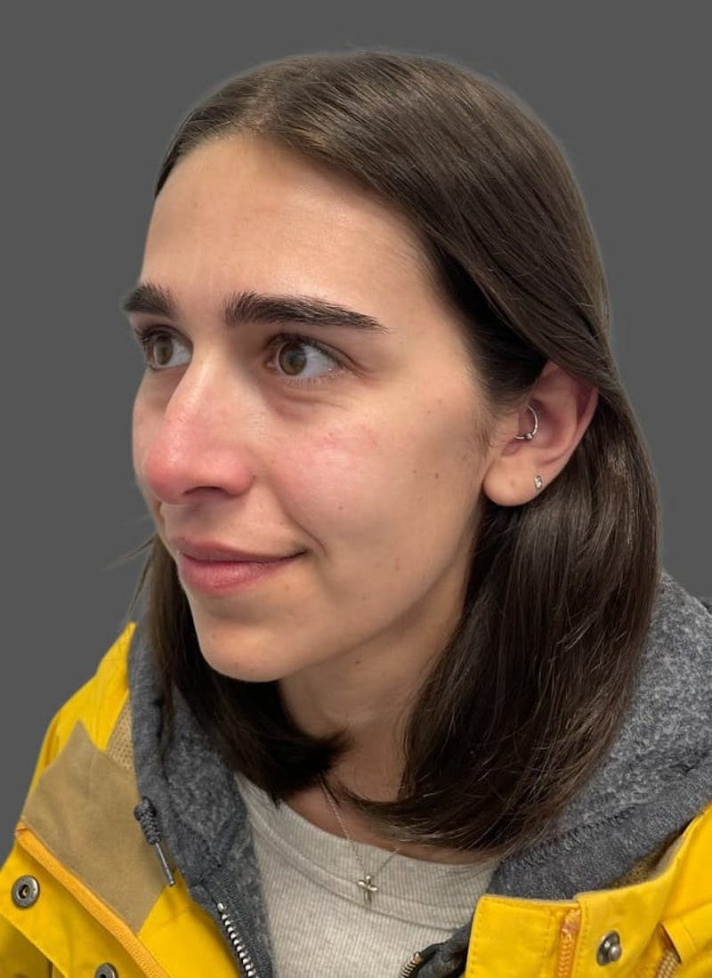 Rhinoplasty Before & After Gallery - Patient 600754 - Image 5