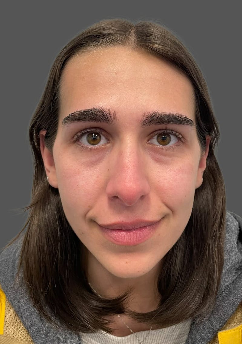 Rhinoplasty Before & After Gallery - Patient 600754 - Image 9