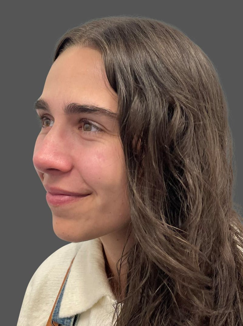 Rhinoplasty Before & After Gallery - Patient 600754 - Image 6