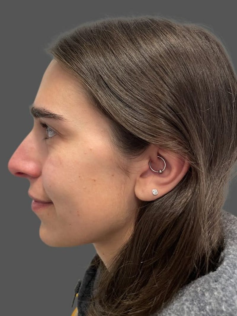 Rhinoplasty Before & After Gallery - Patient 600754 - Image 1