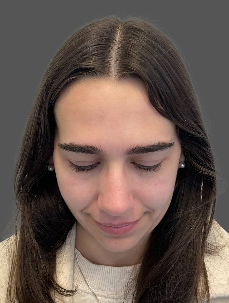 Rhinoplasty Before & After Gallery - Patient 600754 - Image 12