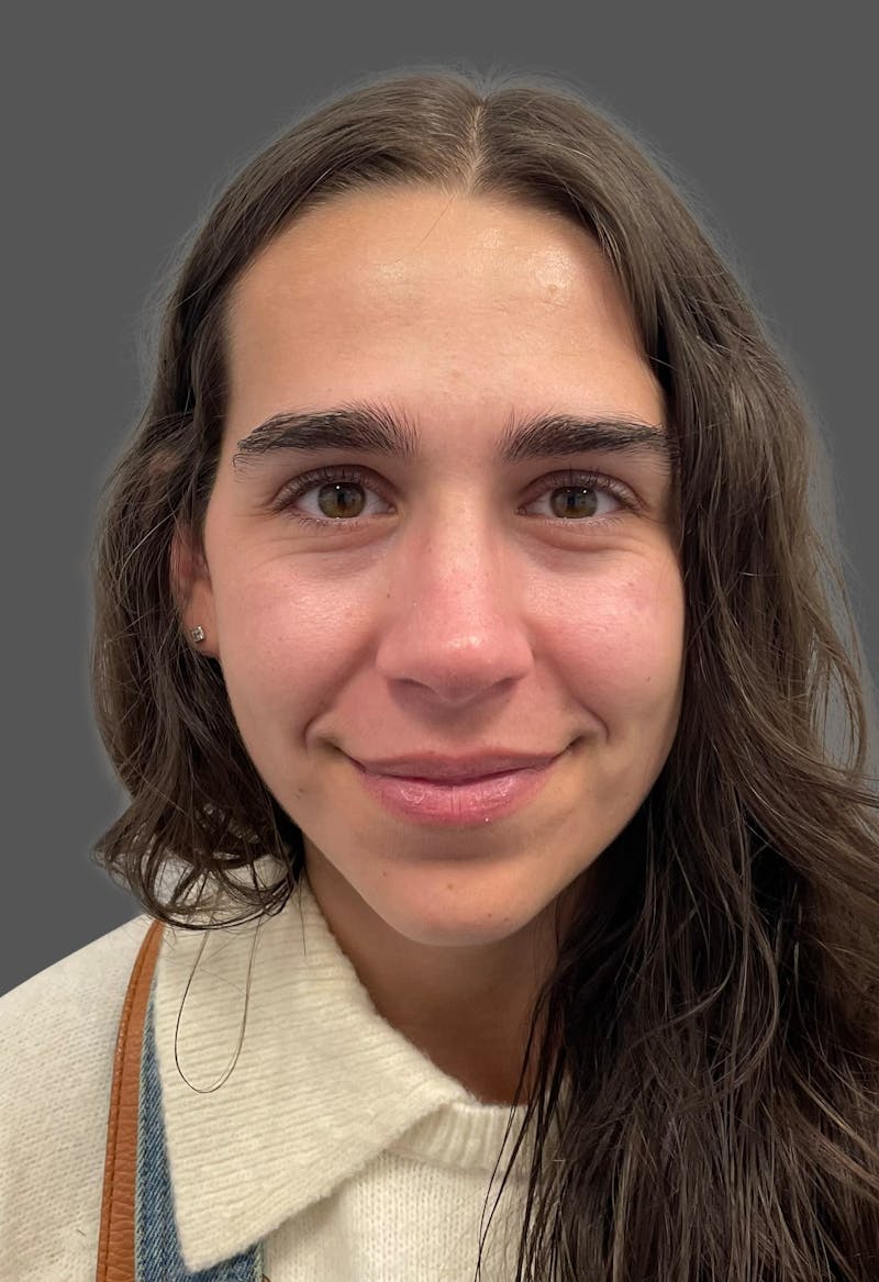 Rhinoplasty Before & After Gallery - Patient 600754 - Image 10
