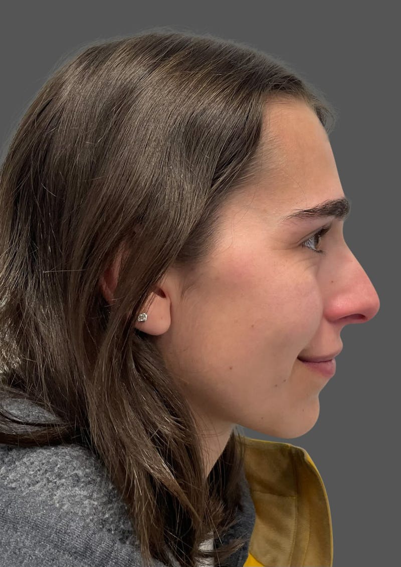 Rhinoplasty Before & After Gallery - Patient 600754 - Image 7