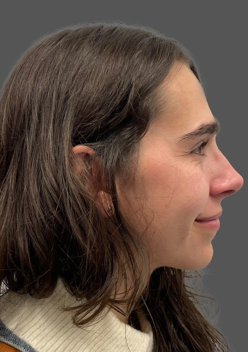 Rhinoplasty Before & After Gallery - Patient 600754 - Image 8