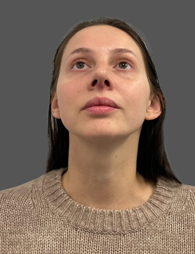 Rhinoplasty Before & After Gallery - Patient 368271 - Image 8