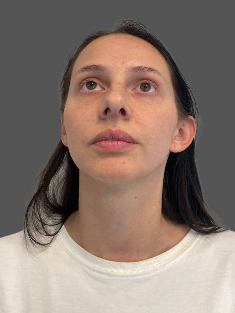 Rhinoplasty Before & After Gallery - Patient 368271 - Image 7