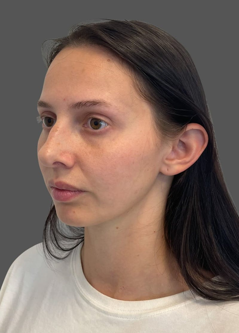 Rhinoplasty Before & After Gallery - Patient 368271 - Image 3